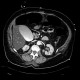 Renal infarction, biliary excretion of contrast: CT - Computed tomography